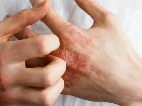 Câu chuyện về nỗi ám ảnh ‘nửa sống nửa chết’ vì loại thuốc hàng triệu người tin dùng